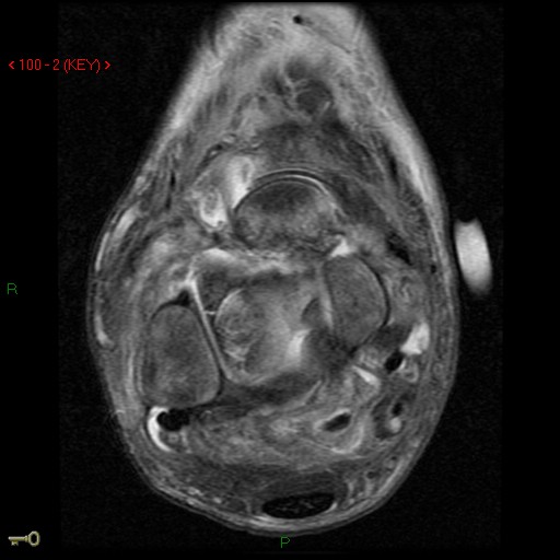 Figure 5 for case AVN talus